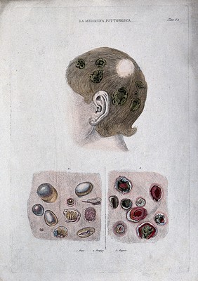 Skin diseases: a child's head with symptoms of favus; bottom left, pemphigus; bottom right, scabs on sores. Coloured engraving, 1834-1837.