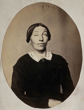 A woman, with one eye partially closed and the other eye rolling upwards, in a dress with a lace collar. Photograph, ca. 1865.