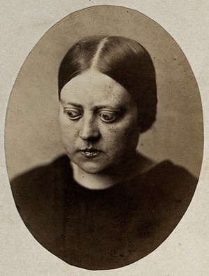 view A woman, with bulging eyes, looking downwards. Photograph, 1864.