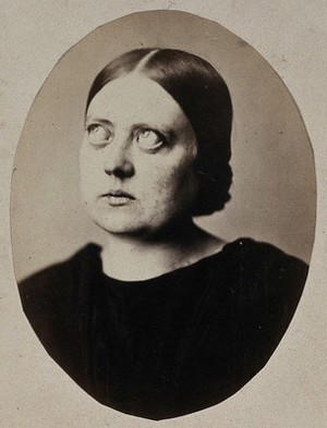 view A woman, with bulging eyes, looking upwards. Photograph, 1864.