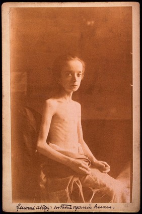 Muscular atrophy: a thin bare-chested child. Photograph, 1860/1880.