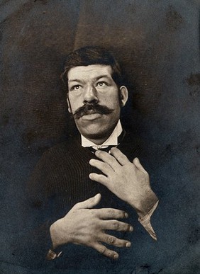 Acromegaly: a man with enlarged nose, jaw and hands due to a pituitary gland disease. Photograph (by E. H. Cobb ?), 1870/1890.