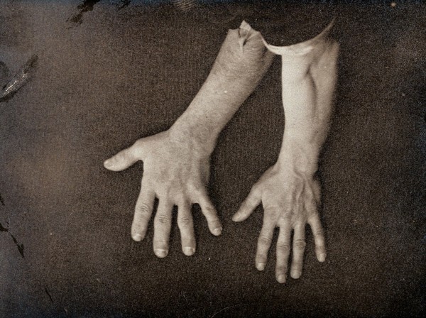 Acromegaly: a comparison between a hand enlarged due to a pituitary gland disease and an adjacent healthy hand. Photograph (by E. H. Cobb ?), 1870/1890.