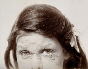 view Herpes simplex: a girl with sores around her eyes. Photograph by S. H. Cannon, ca. 1920 (?).