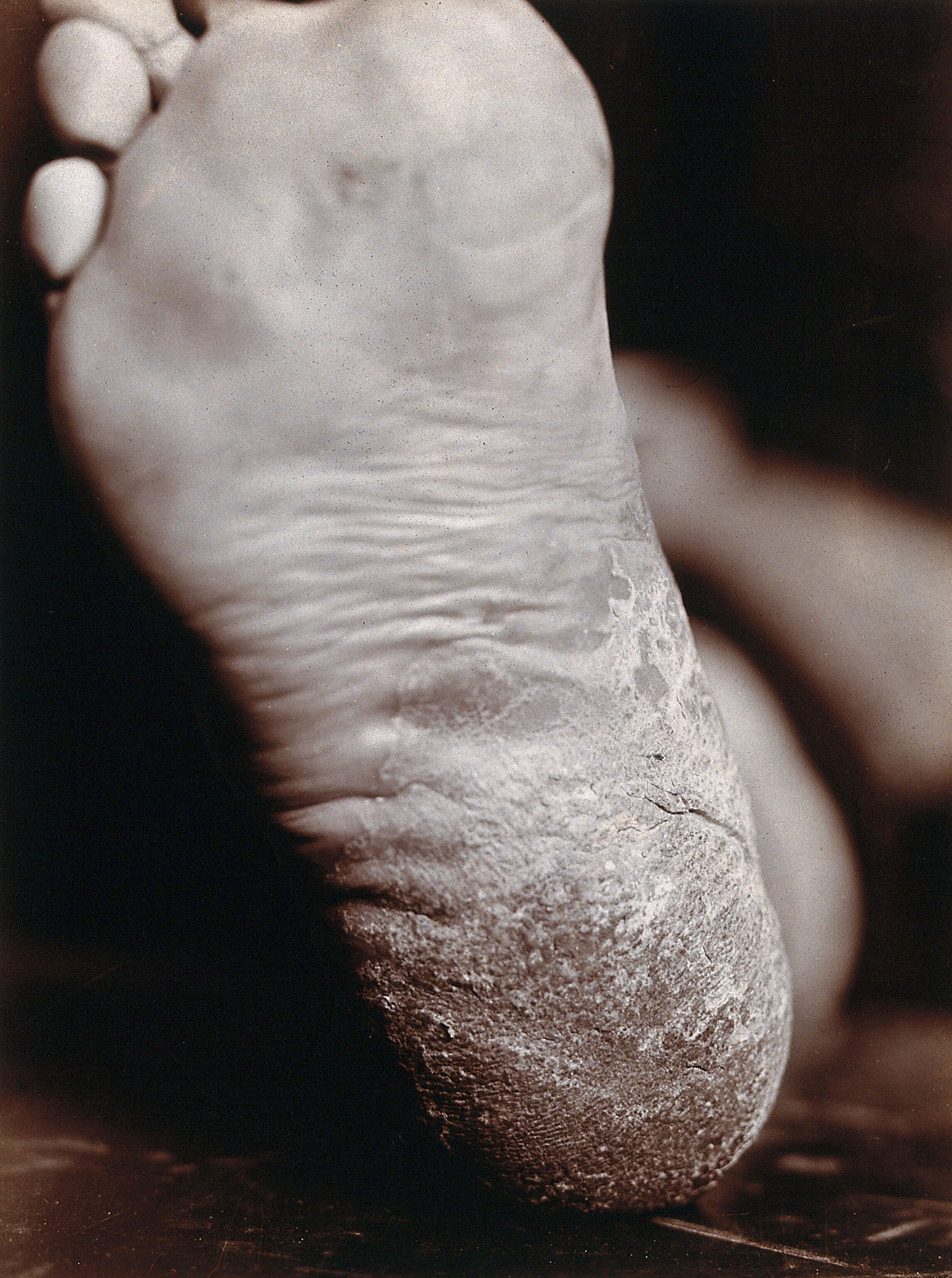 Dermatology Thick Skin On The Sole Of A Foot Photograph By S H dermatology-thick-skin-on-the-sole-of-a-foot-photograph-by-s-h