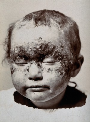 view Eczema: a small child with sores on the face. Photograph by S. H. Cannon, ca. 1920 (?).