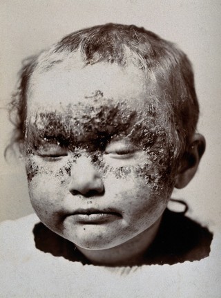 Eczema: a small child with sores on the face. Photograph by S. H. Cannon, ca. 1920 (?).