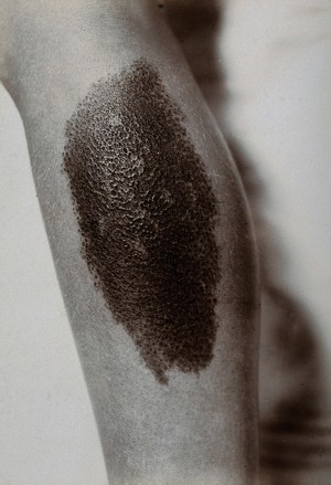 view Dermatology: a large pigmented mole on an arm. Photograph by S. H. Cannon, ca. 1920 (?).