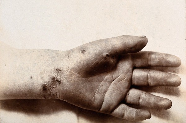 Scabies: sores on a hand, palm upwards. Photograph by S. H. Cannon, ca. 1920 (?).