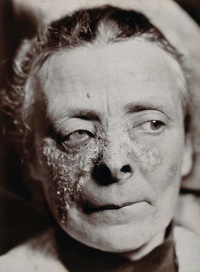 Lupus: a man with sores on his face. Photograph by S. H. Cannon, ca. 1920 (?).