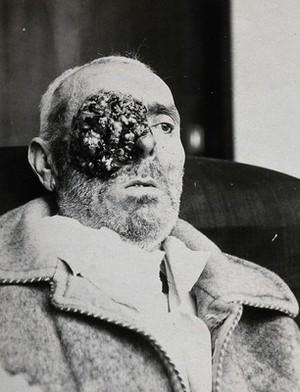 view Epithelioma of the eye on the patient Arthur Howard, the Glasgow Royal Cancer Hospital. Photograph, 1925.