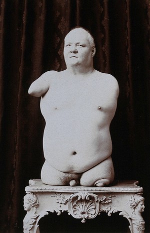 view A man without arms and legs posing naked on a table, front view.