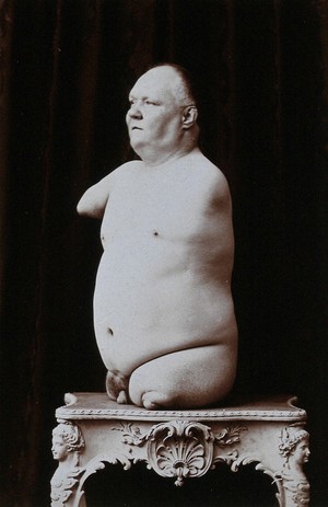 A man without arms and legs posing naked on a table, side view.