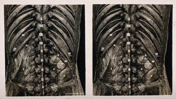 Anatomy: a dissection of the lumbar region showing the posterior relations of the kidneys. Photograph, ca. 1900.