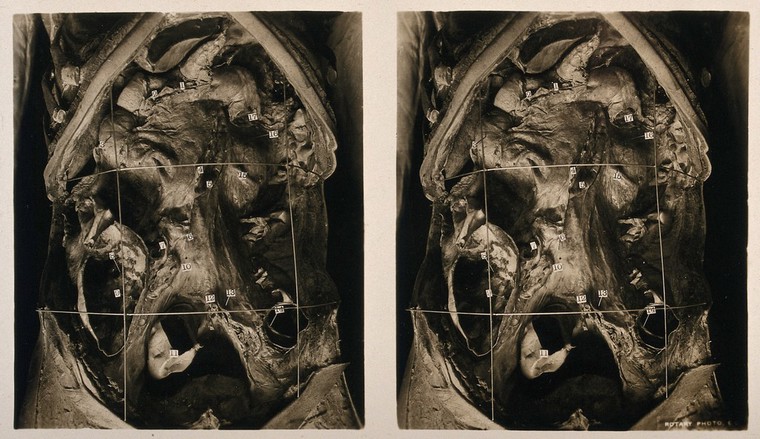 Anatomy: a dissection of the abdomen showing the abdominal cavity