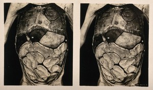 view Anatomy: a dissection of the abdomen showing the abdominal cavity. Photograph, ca. 1900.