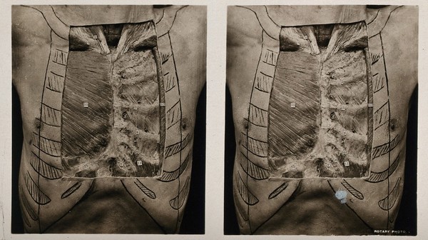 Anatomy: a dissection of the thorax: the anterior thoracic wall. Photograph, ca. 1900.