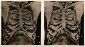 view Anatomy: a dissection of the thorax: the thorax wall. Photograph, ca. 1900.