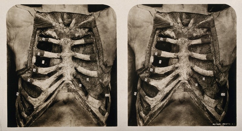 Anatomy: a dissection of the thorax showing the heart ...