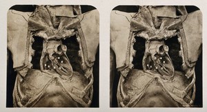 view Anatomy: a dissection of the thorax showing the ventricular chambers of the heart. Photograph, ca. 1900.