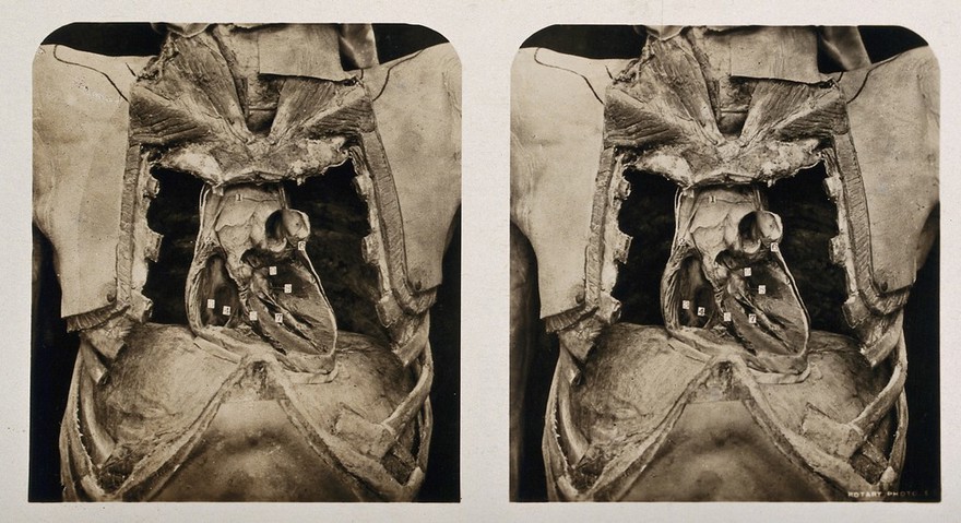 Anatomy: a dissection of the thorax showing the ventricular chambers of the heart. Photograph, ca. 1900.