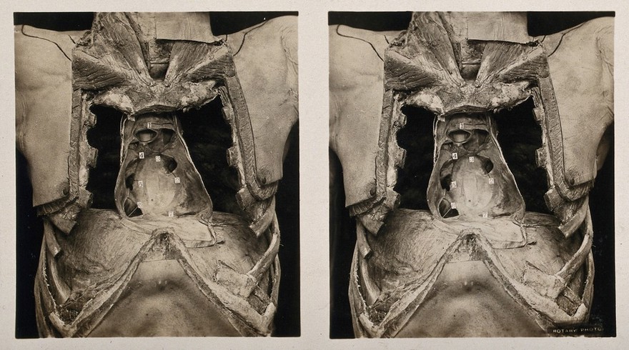 Anatomy: a dissection of the thorax showing the heart and pericardium. Photograph, ca. 1900.