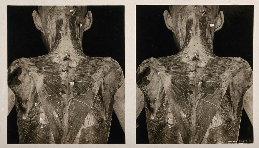 Anatomy: écorché human back, showing cutaneous nerves and the first layer of muscle. Photograph, ca. 1900.