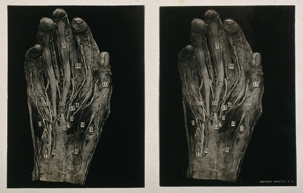 Anatomy: écorché palm of the hand showing muscles, nerves, vessels and tendons. Photograph, ca. 1900.