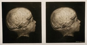 view Anatomy: a head with the skull removed showing meninges. Photograph, ca. 1900.