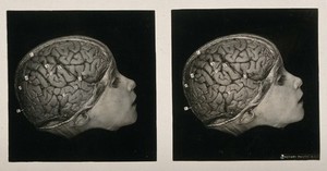 Anatomy: a head with part of the skull removed showing the gyri of the brain.  Photograph, ca. 1900.