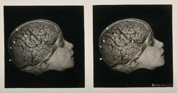 Anatomy: a head with part of the skull removed showing the gyri of the brain. Photograph, ca. 1900.