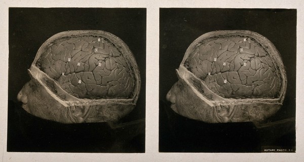 Anatomy: section of the brain showing fissures on the left cerebral hemisphere. Photograph, ca. 1900.