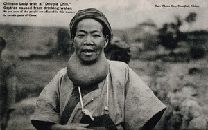 view A Chinese woman with goitre. Photographic postcard after Burr Photo Co., ca. 1930.