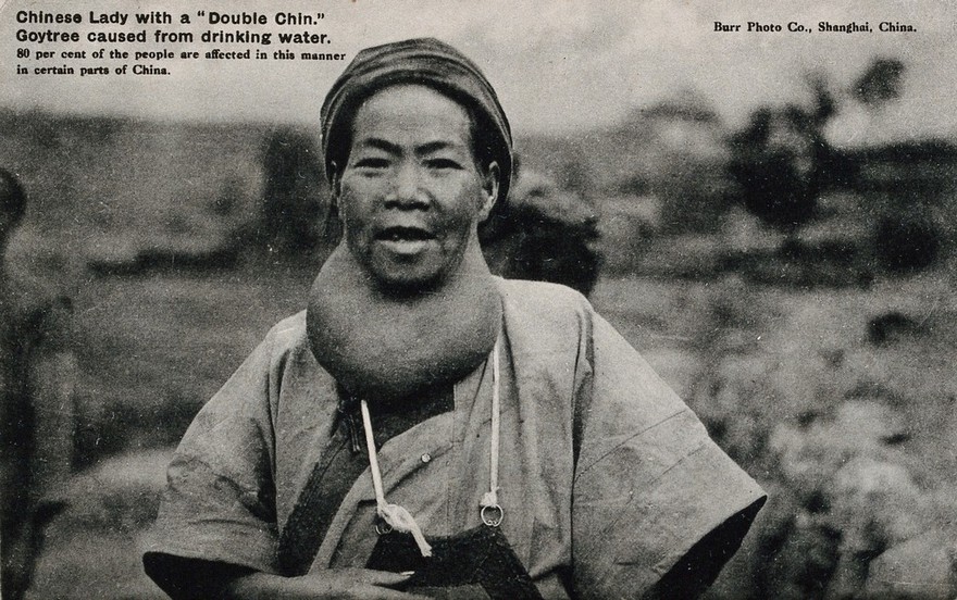A Chinese woman with goitre. Photographic postcard after Burr Photo Co., ca. 1930.