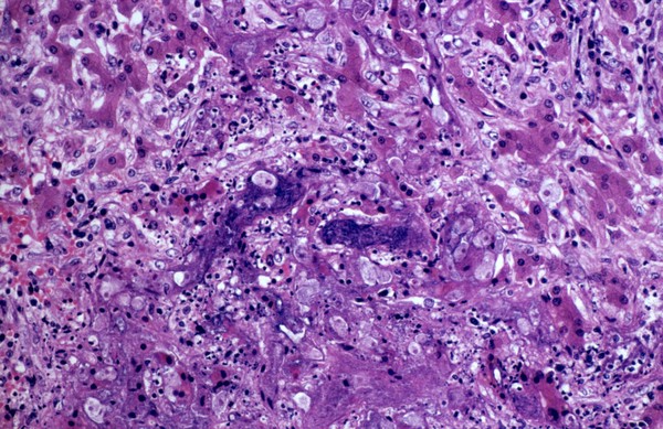 Amoebiasis: amoebic abscess in liver