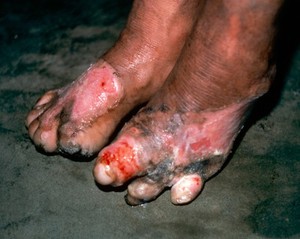 view Leprosy: scalded feet