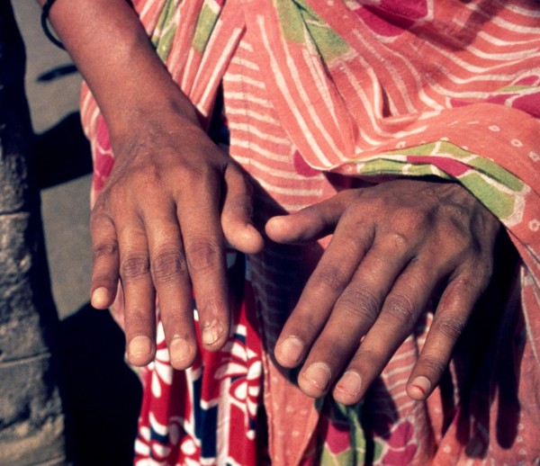 Leprosy treatment: post surgery