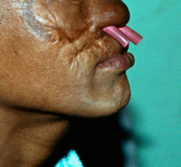 Leprosy: treatment: post surgery