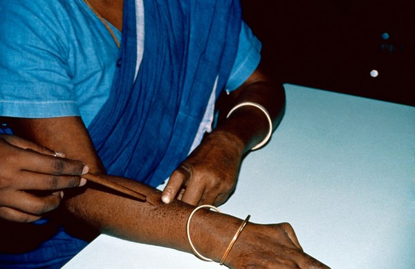 Leprosy: sensory testing