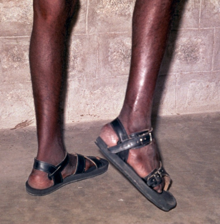 Leprosy footdrop Collection