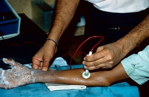 view Leprosy: electrotherapy