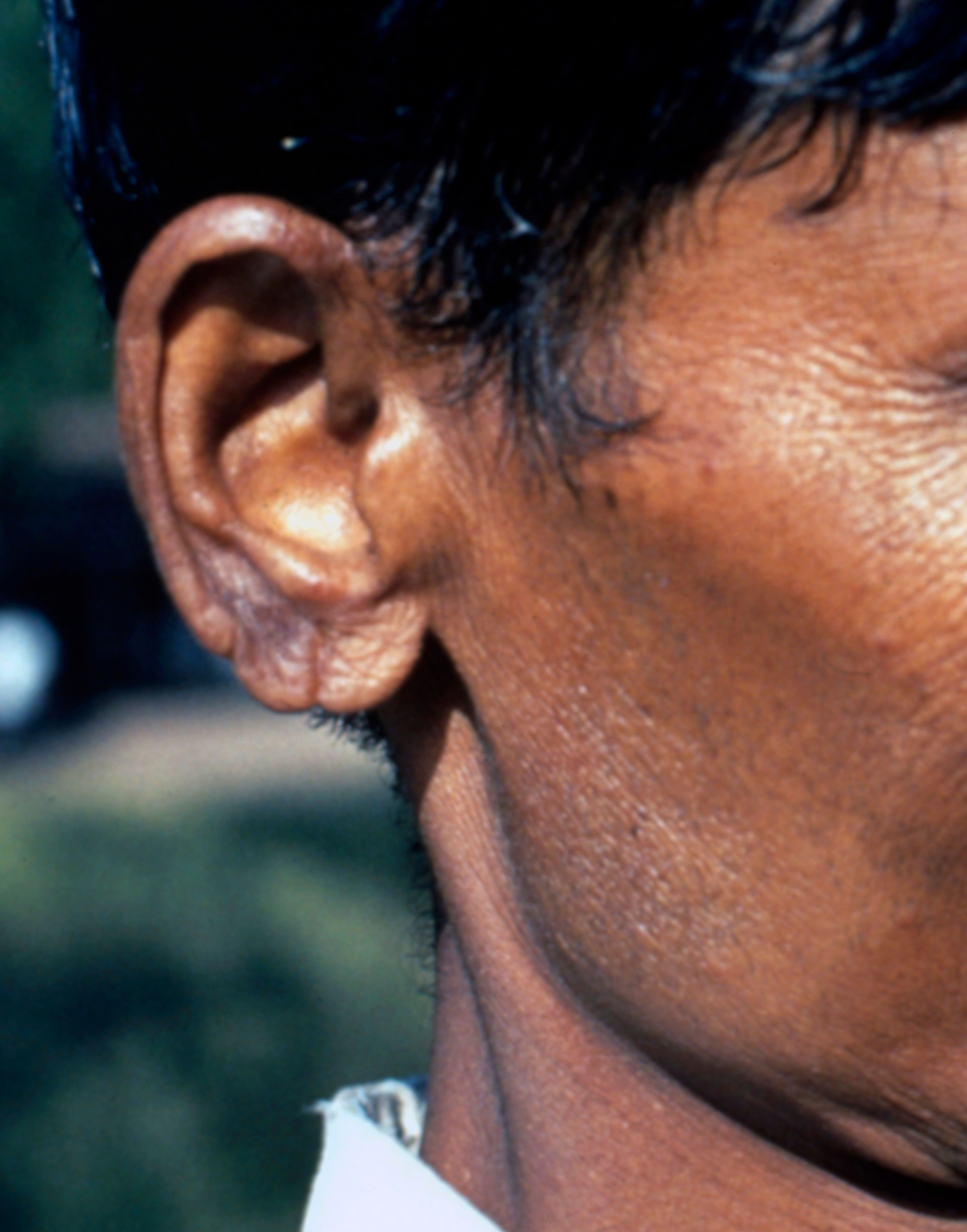 Lepromatous Leprosy Ll Multidrug Therapy Mdt Wellcome Collection