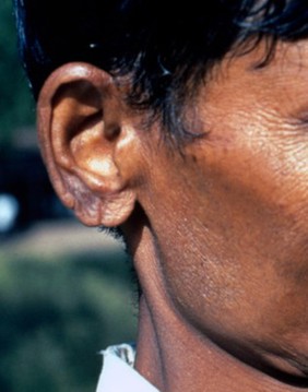 Lepromatous leprosy (LL): multidrug therapy (MDT)