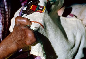 view Leprosy: occupational health