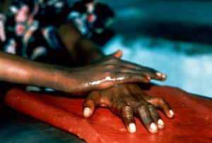 view Leprosy: daily hand care