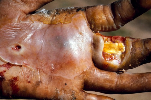 Leprosy: complications