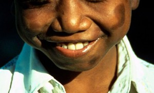 view Mid-borderline leprosy: side effects of chemotherapy