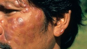 view Leprosy: borderline lepromatous leprosy