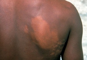 view Leprosy: borderline tuberculoid leprosy