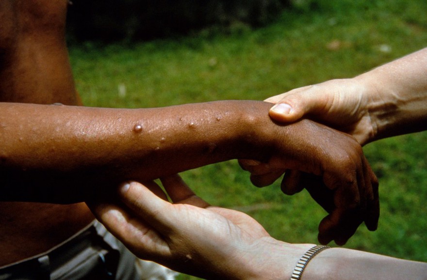 Leprosy: lepromatous leprosy - histoid leprosy